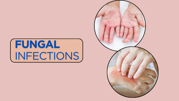 Fungal Infections